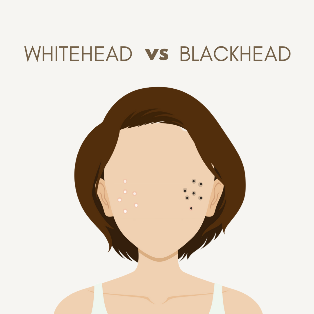 Whitehead vs Blackhead